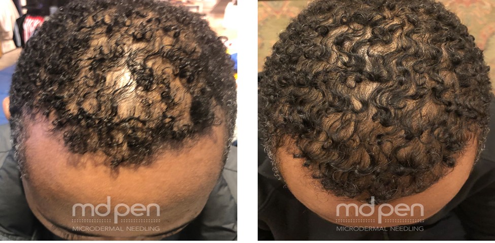 Hair Restoration with Medical Microneedling