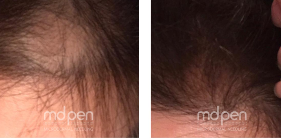 Before & After Hair Restoration