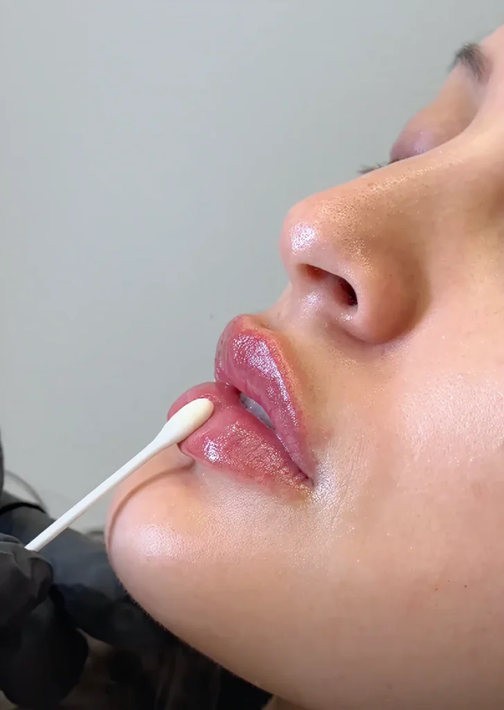 Clinic lip fill treatment
