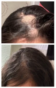 Hair Loss Treatment