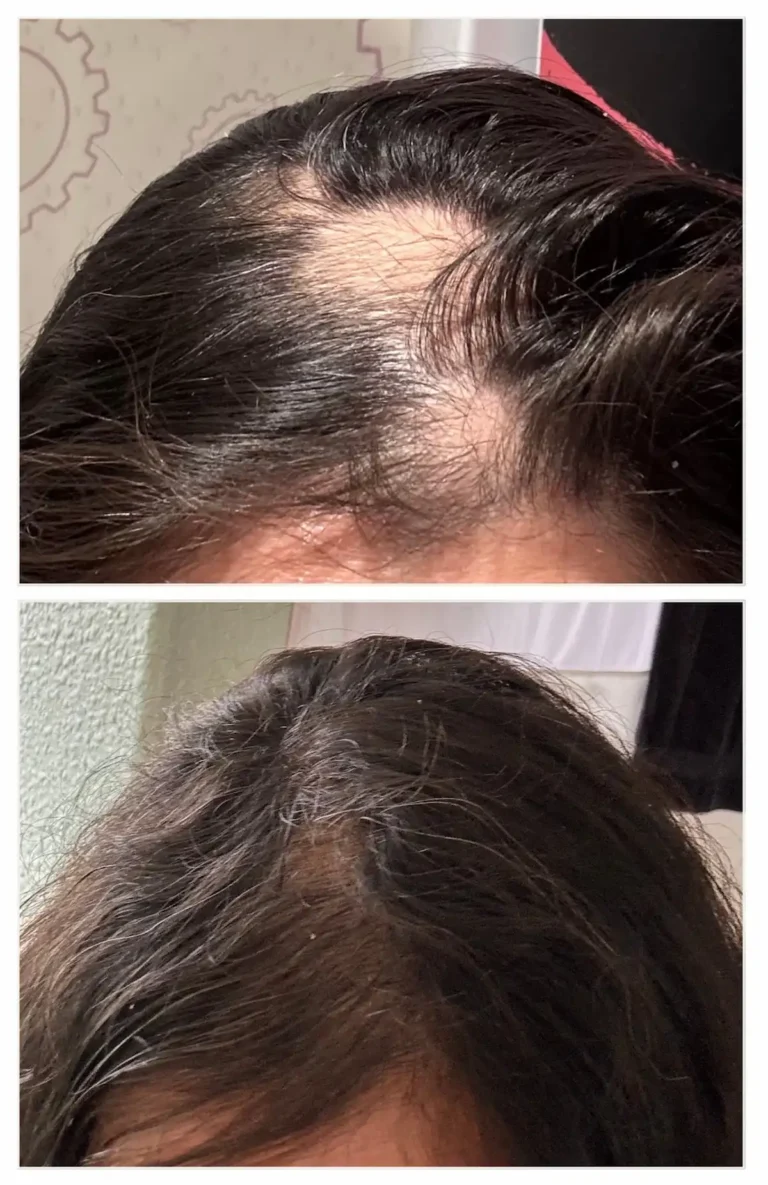 Hair Loss Treatment