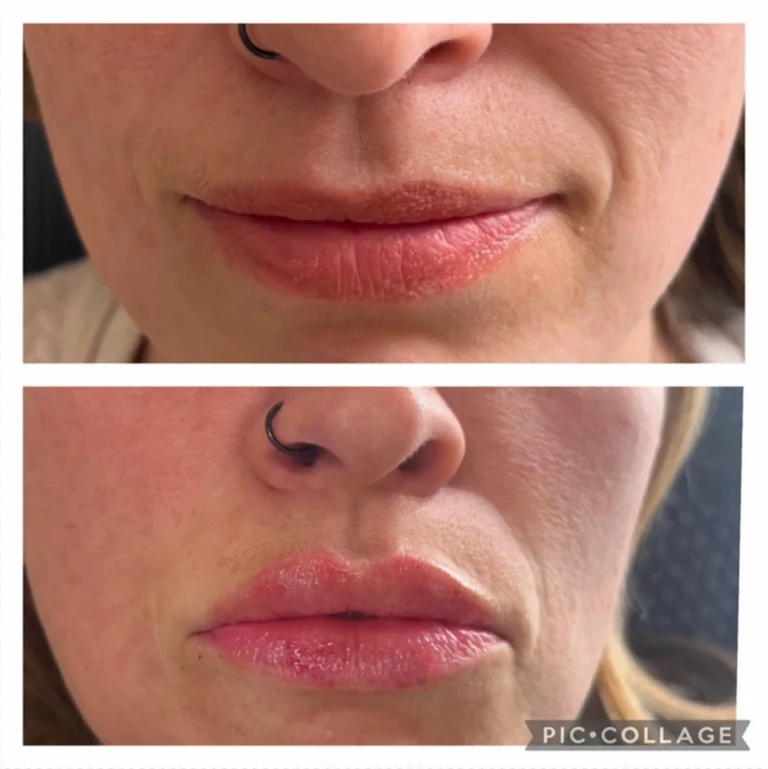 Injectables: Lip Enhancement w/ Dermal Filler