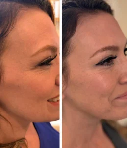 Wrinkle Relaxers: Crow’s Feet
