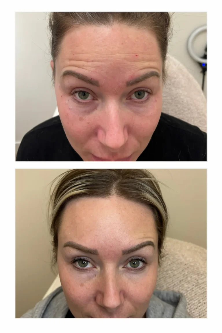 Wrinkle Relaxers:
Forehead and Between the Brows