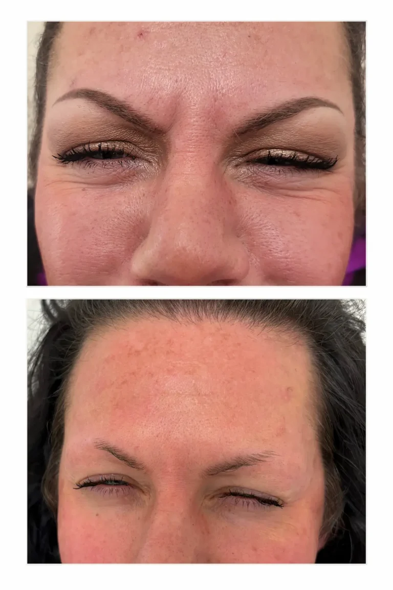Wrinkle Relaxers:
Forehead and Between the Brows