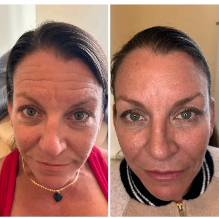 Wrinkle Relaxers:
Forehead and Between the Brows