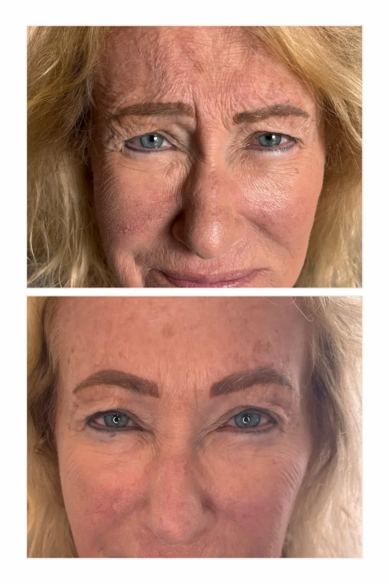 Wrinkle Relaxers:
Forehead and Between the Brows
